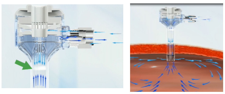 一次性使用腹部穿刺器注冊審查指導(dǎo)原則(2021年第103號)(圖2) 一次性使用腹部穿刺器注冊審查指導(dǎo)原則(2021年第103號)(圖2)