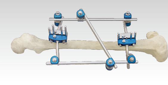 骨科外固定支架注冊技術(shù)審查指導(dǎo)原則(2018年修訂)(2018年第107號)(圖1) 骨科外固定支架注冊技術(shù)審查指導(dǎo)原則(2018年修訂)(2018年第107號)(圖1)